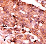 Formalin-fixed and paraffin-embedded human cancer tissue reacted with the primary antibody, which was peroxidase-conjugated to the secondary antibody, followed by AEC staining. This data demonstrates the use of this antibody for immunohistochemistry; clinical relevance has not been evaluated. BC = breast carcinoma; HC = hepatocarcinoma.