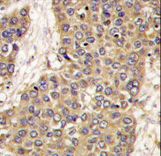 Formalin-fixed and paraffin-embedded human hepatocarcinoma tissue reacted with CASP6 antibody , which was peroxidase-conjugated to the secondary antibody, followed by DAB staining. This data demonstrates the use of this antibody for immunohistochemistry; clinical relevance has not been evaluated.
