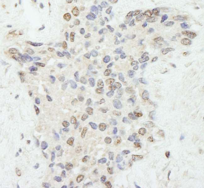 Detection of Human FLASH by Immunohistochemistry. Sample: FFPE section of human prostate nodular hypertrophy. Antibody: Affinity purified rabbit anti-FLASH used at a dilution of 1:250.