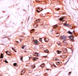 Formalin-fixed and paraffin-embedded human cancer tissue reacted with the primary antibody, which was peroxidase-conjugated to the secondary antibody, followed by AEC staining. This data demonstrates the use of this antibody for immunohistochemistry; clinical relevance has not been evaluated. BC = breast carcinoma; HC = hepatocarcinoma.
