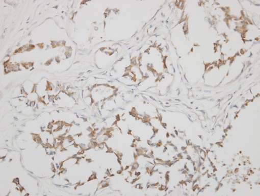 IHC of paraffin-embedded SNU16 xenograft using Calsequestrin 1 antibody at 1:500 dilution.