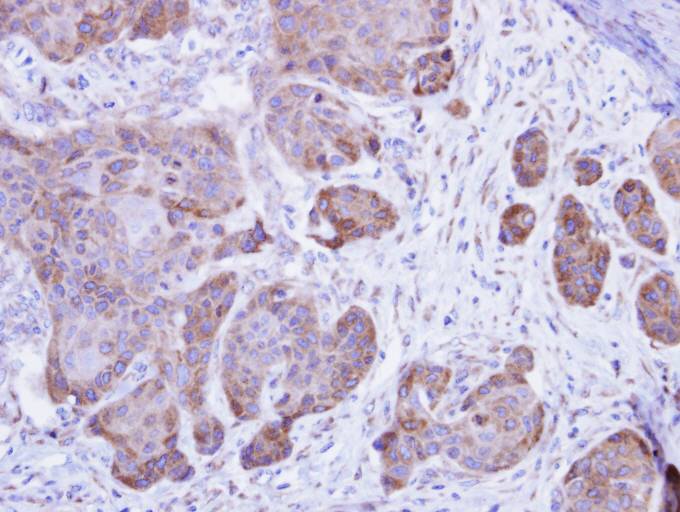 IHC of paraffin-embedded Cal27 xenograft using Calsequestrin-2 antibody at 1:500 dilution.