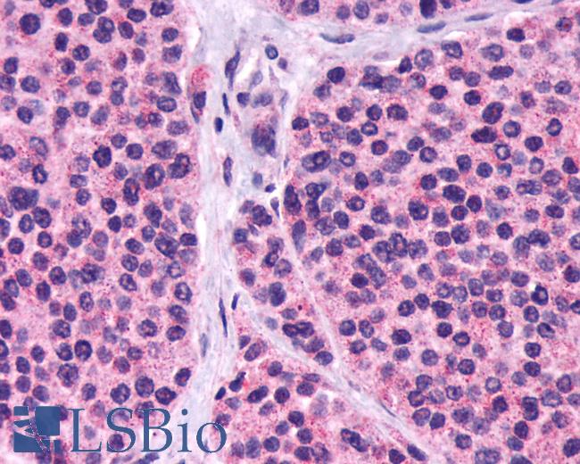 Anti-CASR/Calcium Sensing Receptor antibody IHC of human Thyroid, Medullary Carcinoma. Immunohistochemistry of formalin-fixed, paraffin-embedded tissue after heat-induced antigen retrieval.