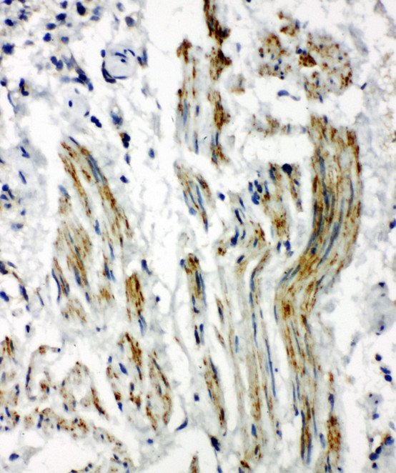 CAV2 / Caveolin 2 antibody. IHC(P): Human Lung Cancer Tissue.