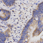 Immunohistochemistry of paraffin-embedded human rectal cancer using CBLB antibody at dilution of 1:200 (x400 lens)