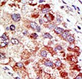 Formalin-fixed and paraffin-embedded human cancer tissue reacted with the primary antibody, which was peroxidase-conjugated to the secondary antibody, followed by AEC staining. This data demonstrates the use of this antibody for immunohistochemistry; clinical relevance has not been evaluated. BC = breast carcinoma; HC = hepatocarcinoma.