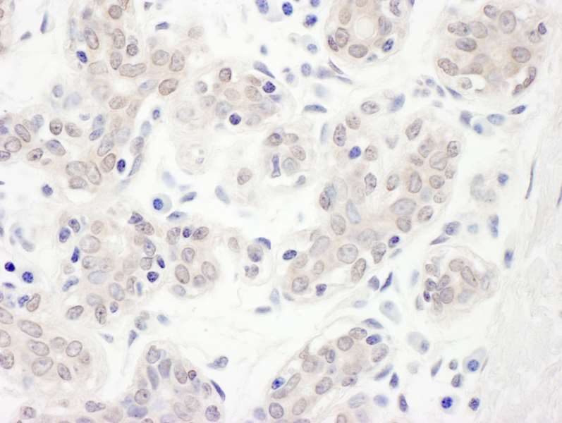 Detection of Human Hakai by Immunohistochemistry. Sample: FFPE section of human breast carcinoma. Antibody: Affinity purified rabbit anti-Hakai used at a dilution of 1:1000 (1 ug/ml). Detection: DAB.
