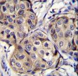 CBLN2 Antibody immunohistochemistry of formalin-fixed and paraffin-embedded human breast carcinoma followed by peroxidase-conjugated secondary antibody and DAB staining.