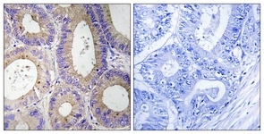 IHC of paraffin-embedded human colon carcinoma tissue, using CBR3 Antibody. The picture on the right is treated with the synthesized peptide.