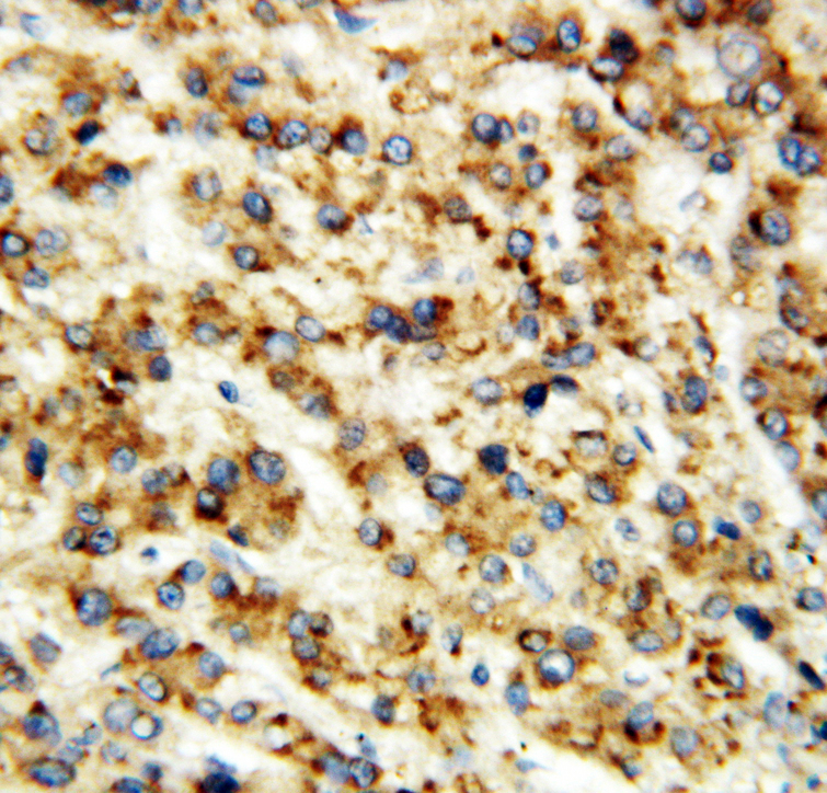 CBS antibody. IHC(P): Human Liver Cancer Tissue.