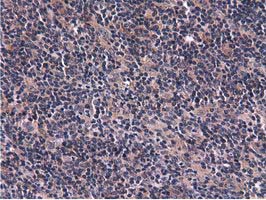 IHC of paraffin-embedded Human lymphoma tissue using anti-CBWD1 mouse monoclonal antibody.