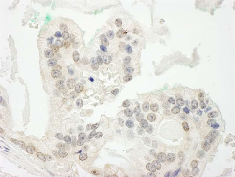 Detection of Human CBX6 by Immunohistochemistry. Sample: FFPE section of human prostate carcinoma. Antibody: Affinity purified rabbit anti-CBX6 used at a dilution of 1:250.
