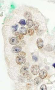 Detection of Human CBX6 by Immunohistochemistry. Sample: FFPE section of human prostate carcinoma. Antibody: Affinity purified rabbit anti-CBX6 used at a dilution of 1:1000 (1 ug/ml).