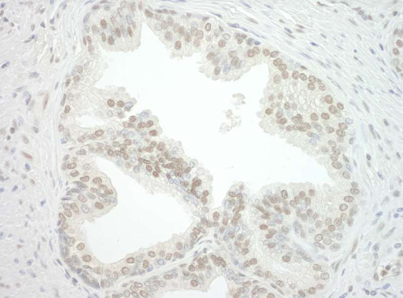 Detection of Human CBX7 by Immunohistochemistry. Sample: FFPE section of human prostate carcinoma. Antibody: Affinity purified rabbit anti-CBX7 used at a dilution of 1:250.