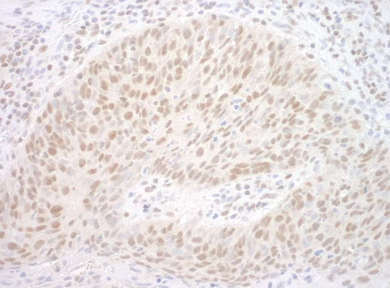 Detection of Human CBX7 by Immunohistochemistry. Sample: FFPE section of human lung carcinoma. Antibody: Affinity purified rabbit anti-CBX7 used at a dilution of 1:200 (1 ug/ml).