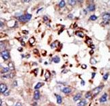 Formalin-fixed and paraffin-embedded human cancer tissue reacted with the primary antibody, which was peroxidase-conjugated to the secondary antibody, followed by DAB staining. This data demonstrates the use of this antibody for immunohistochemistry; clinical relevance has not been evaluated. BC = breast carcinoma; HC = hepatocarcinoma.