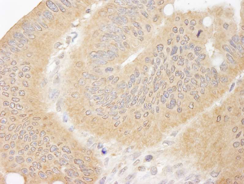 Detection of Human CC2D1A by Immunohistochemistry. Sample: FFPE section of human colon carcinoma. Antibody: Affinity purified rabbit anti-CC2D1A used at a dilution of 1:1000 (1 ug/ml).