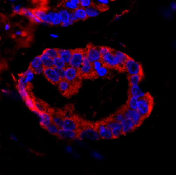 Detection of Human CC2D1A by Immunohistochemistry. Sample: FFPE section of human prostate carcinoma Antibody: Affinity purified rabbit anti-CC2D1A7 used at a dilution of 1:100. Detection: Red-fluorescent goat anti-rabbit IgG highly cross-adsorbed Antibody used at a dilution of 1:100.