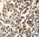 CCDC110 Antibody immunohistochemistry of formalin-fixed and paraffin-embedded human testis carcinoma followed by peroxidase-conjugated secondary antibody and DAB staining.