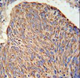 CC130 Antibody IHC of formalin-fixed and paraffin-embedded human lung carcinoma followed by peroxidase-conjugated secondary antibody and DAB staining.