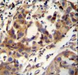 CCDC17 antibody immunohistochemistry of formalin-fixed and paraffin-embedded human breast carcinoma followed by peroxidase-conjugated secondary antibody and DAB staining.