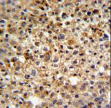 KIAA1529 Antibody IHC of formalin-fixed and paraffin-embedded human cervix carcinoma followed by peroxidase-conjugated secondary antibody and DAB staining.