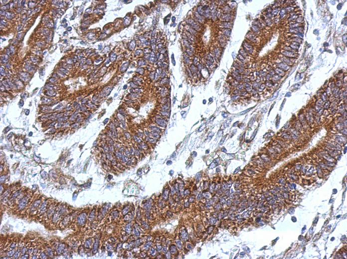 IHC of paraffin-embedded Colon ca, using CCDC37 antibody at 1:500 dilution.