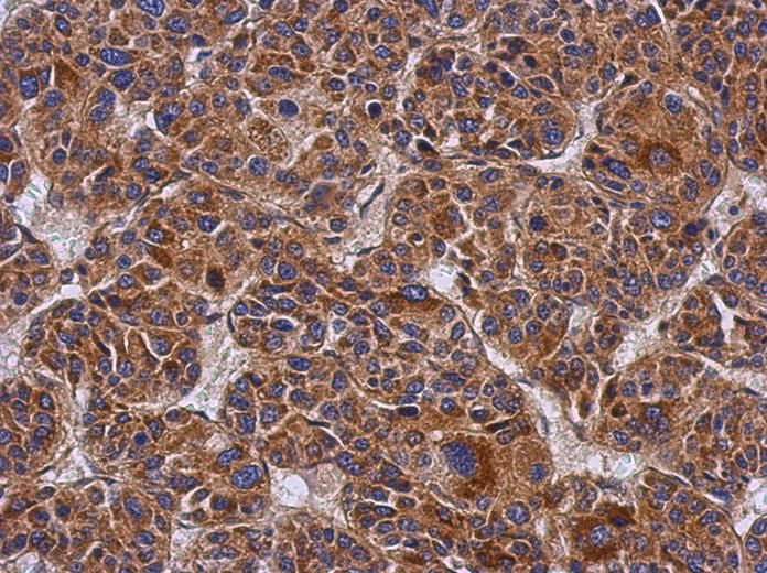 IHC of paraffin-embedded Hepatoma, using Ymer antibody at 1:500 dilution.