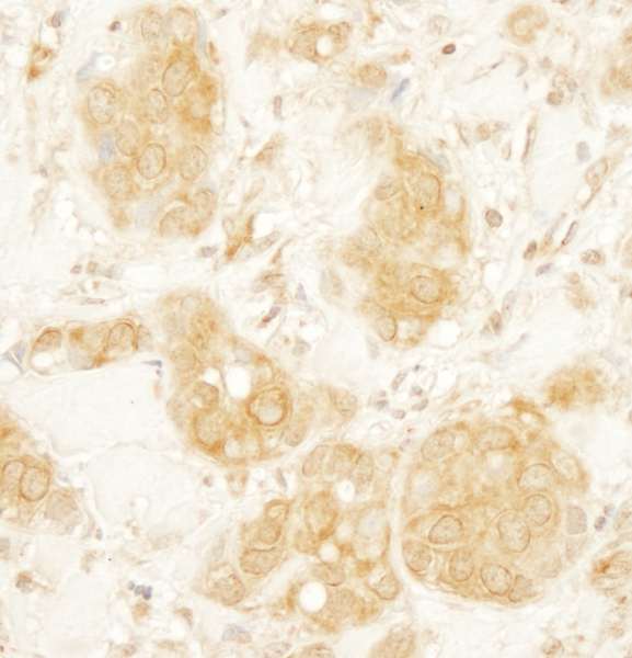 Detection of Human Ymer by Immunohistochemistry. Sample: FFPE section of human breast carcinoma. Antibody: Affinity purified rabbit anti-Ymer used at a dilution of 1:1000 (1 ug/ml). Detection: DAB.