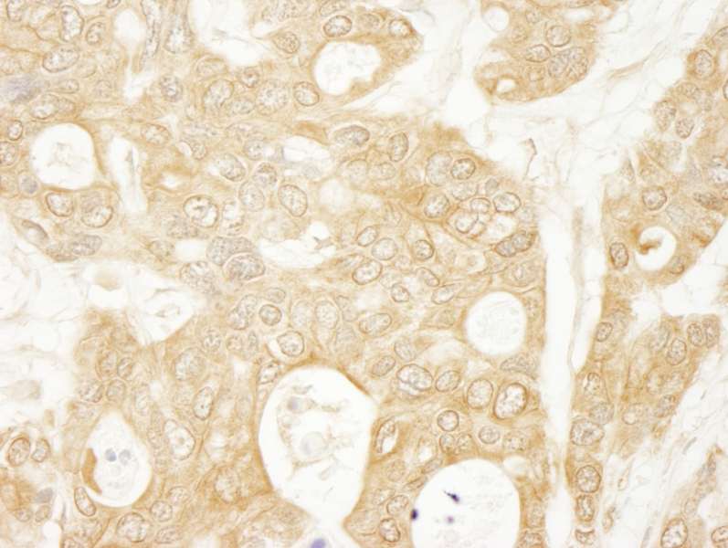 Detection of Human Ymer by Immunohistochemistry. Sample: FFPE section of human ovarian carcinoma. Antibody: Affinity purified rabbit anti-Ymer used at a dilution of 1:250.