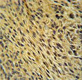 CCDC62 Antibody immunohistochemistry of formalin-fixed and paraffin-embedded human lung carcinoma followed by peroxidase-conjugated secondary antibody and DAB staining.