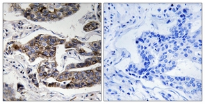 IHC of paraffin-embedded human breast carcinoma, using Girdin (Phospho-Ser1417) Antibody. The sample on the right was incubated with synthetic peptide.