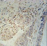 CCD92 Antibody immunohistochemistry of formalin-fixed and paraffin-embedded human colon carcinoma followed by peroxidase-conjugated secondary antibody and DAB staining.