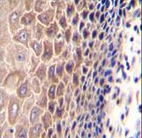 CCDC97 Antibody immunohistochemistry of formalin-fixed and paraffin-embedded human esophageal carcinoma followed by peroxidase-conjugated secondary antibody and DAB staining.