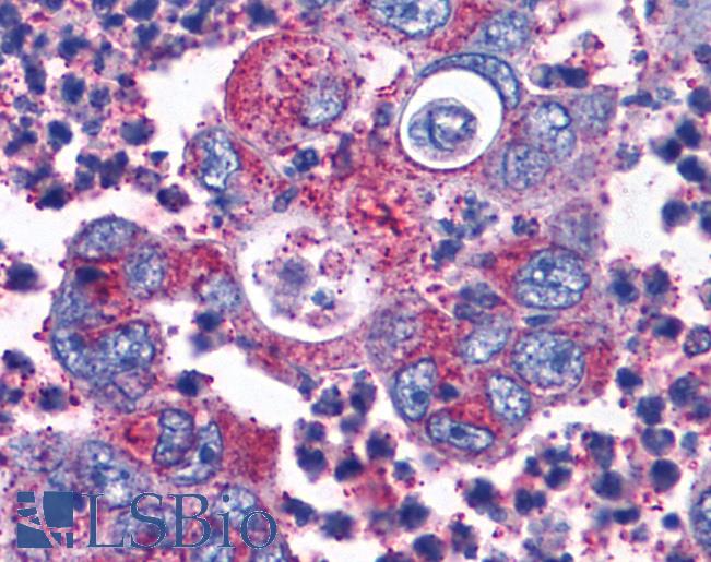 Anti-CCKBR / Cckb antibody IHC of human Colon, Carcinoma. Immunohistochemistry of formalin-fixed, paraffin-embedded tissue after heat-induced antigen retrieval.