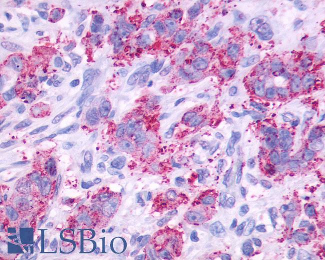 Anti-CCKBR / Cckb antibody IHC of human Stomach, Adenocarcinoma. Immunohistochemistry of formalin-fixed, paraffin-embedded tissue after heat-induced antigen retrieval.