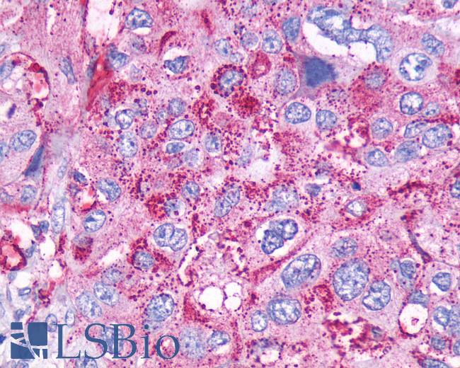 Anti-CCKBR / Cckb antibody IHC of human Pancreas, Carcinoma. Immunohistochemistry of formalin-fixed, paraffin-embedded tissue after heat-induced antigen retrieval.