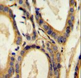CCL4 Antibody immunohistochemistry of formalin-fixed and paraffin-embedded human prostate carcinoma followed by peroxidase-conjugated secondary antibody and DAB staining.