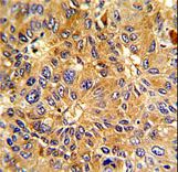 Formalin-fixed and paraffin-embedded human hepatocarcinoma with Cyclin A (CCNA2) Antibody , which was peroxidase-conjugated to the secondary antibody, followed by DAB staining. This data demonstrates the use of this antibody for immunohistochemistry; clinical relevance has not been evaluated.