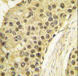 Formalin-fixed and paraffin-embedded human breast carcinoma tissue reacted with CCNA2 antibody , which was peroxidase-conjugated to the secondary antibody, followed by DAB staining. This data demonstrates the use of this antibody for immunohistochemistry; clinical relevance has not been evaluated.