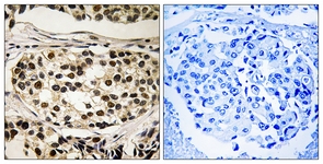IHC of paraffin-embedded human breast carcinoma, using Cyclin C (Phospho-Ser275) Antibody. The sample on the right was incubated with synthetic peptide.