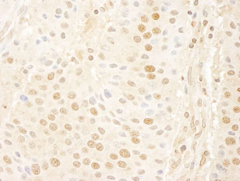 Detection of Human Cyclin C by Immunohistochemistry. Sample: FFPE section of human pancreatic islet cell tumor. Antibody: Affinity purified rabbit anti-Cyclin C used at a dilution of 1:100. Epitope Retrieval Buffer-High pH (IHC-101J) was substituted for Epitope Retrieval Buffer-Reduced pH.