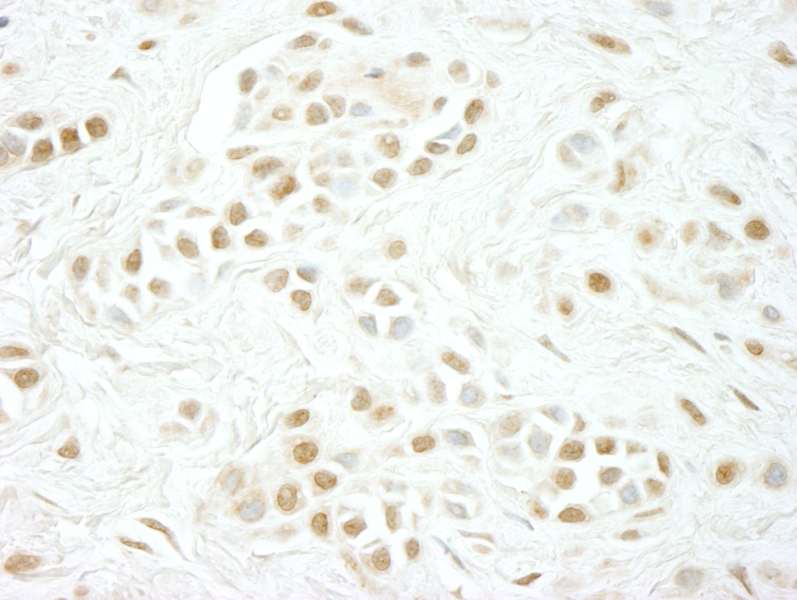 Detection of Human Cyclin C by Immunohistochemistry. Sample: FFPE section of human skin squamous cell carcinoma. Antibody: Affinity purified rabbit anti-Cyclin C used at a dilution of 1:100.