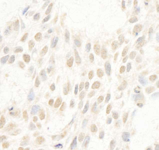 Detection of Human Cyclin C by Immunohistochemistry. Sample: FFPE section of human breast carcinoma. Antibody: Affinity purified rabbit anti-Cyclin C used at a dilution of1:1000 (1 ug/ml). Detection: DAB.