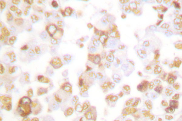 IHC of Cyclin F (I772) pAb in paraffin-embedded human breast carcinoma tissue.