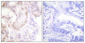 IHC of paraffin-embedded human lung carcinoma tissue, using Cyclin G Antibody. The picture on the right is treated with the synthesized peptide.