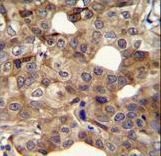 CCNI2 Antibody immunohistochemistry of formalin-fixed and paraffin-embedded human breast carcinoma followed by peroxidase-conjugated secondary antibody and DAB staining.