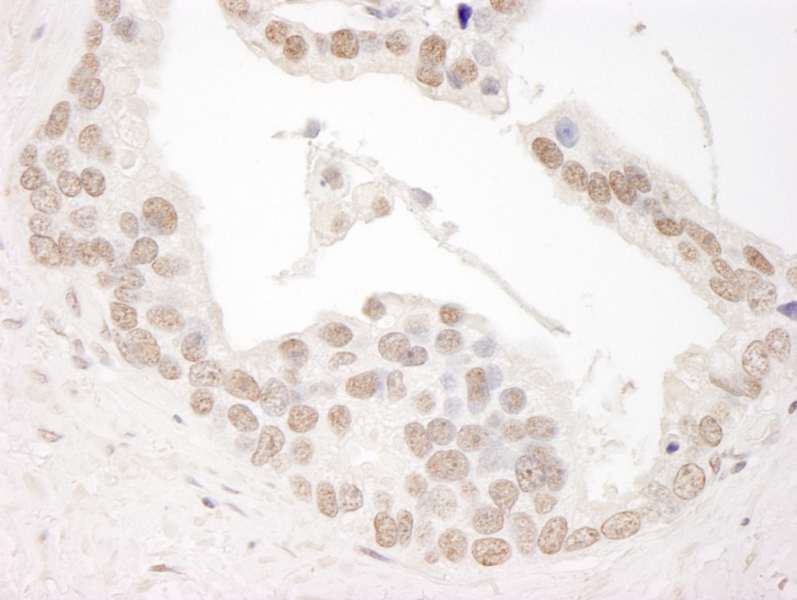 Detection of Human Cyclin L1 by Immunohistochemistry. Sample: FFPE section of human prostate carcinoma. Antibody: Affinity purified rabbit anti-Cyclin L1 used at a dilution of1:1000 (1 ug/ml). Detection: DAB.