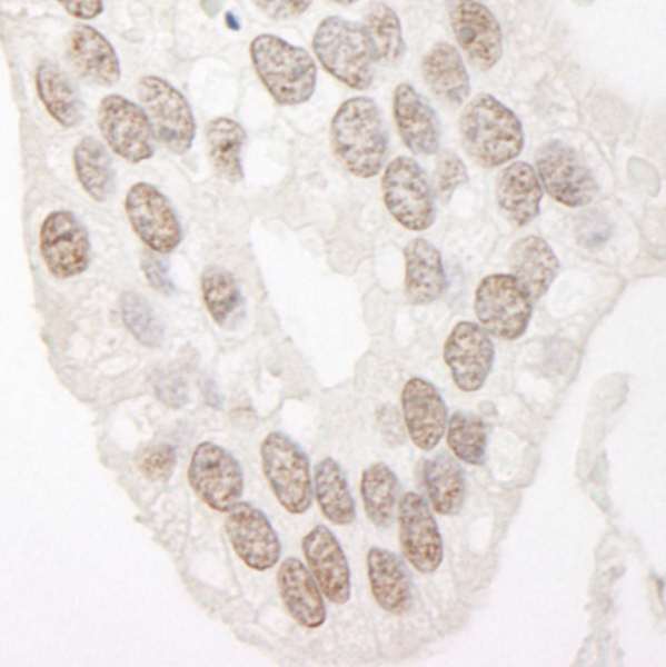 Detection of Human Cyclin L1 by Immunohistochemistry. Sample: FFPE section of human prostate carcinoma. Antibody: Affinity purified rabbit anti-Cyclin L1 used at a dilution of 1:500. Epitope Retrieval Buffer-High pH (IHC-101J) was substituted for Epitope Retrieval Buffer-Reduced pH.