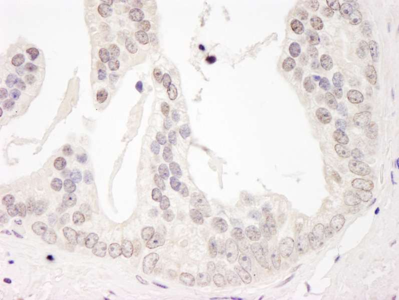 Detection of Human Cyclin L1 by Immunohistochemistry. Sample: FFPE section of human prostate carcinoma. Antibody: Affinity purified rabbit anti-Cyclin L1 used at a dilution of1:1000 (1 ug/ml). Detection: DAB.